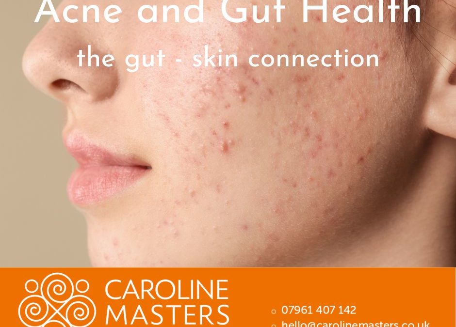 Homeopathy for Acne